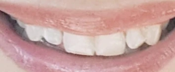 3D Resin-Printed Crowns & Veneers — before
