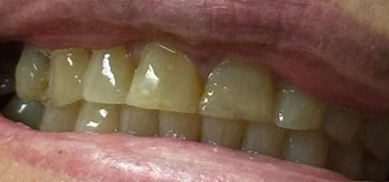 Composite Injection Moulding Restoration — before