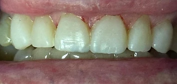 Composite Injection Moulding Restoration — after
