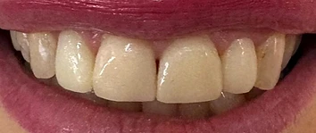 3D Resin-Printed Crowns & Veneers — after