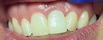 Extraction, Implant, Bone Graft & Implant-Supported Crown — after