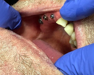 Fixed Bridge on 3 Implants — before