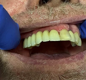 Fixed Bridge on 3 Implants — after