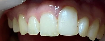 Extraction, Implant, Bone Graft & Implant-Supported Crown — before
