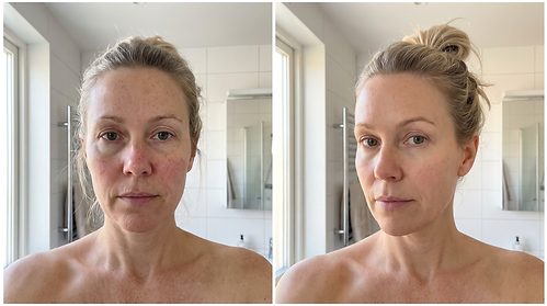 Anna L. — Redness & evenness, week 0 and week 12