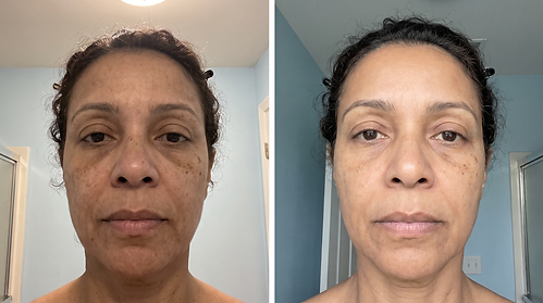 Denise W. — Dark spots & tone, week 0 and week 12