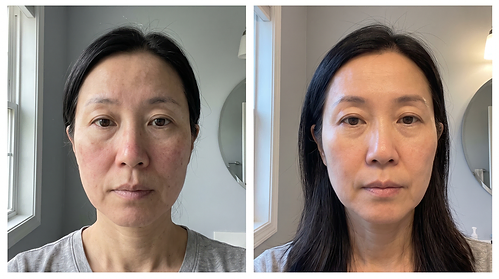 Grace C. — Sensitivity & redness, week 0 and week 12