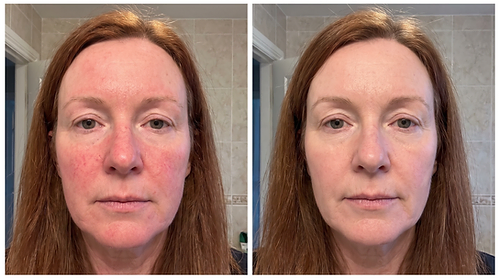 Fiona K. — Redness, week 0 and week 12