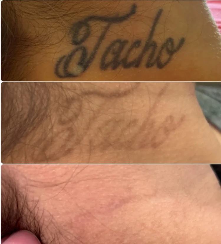 Before and after tattoo removal result