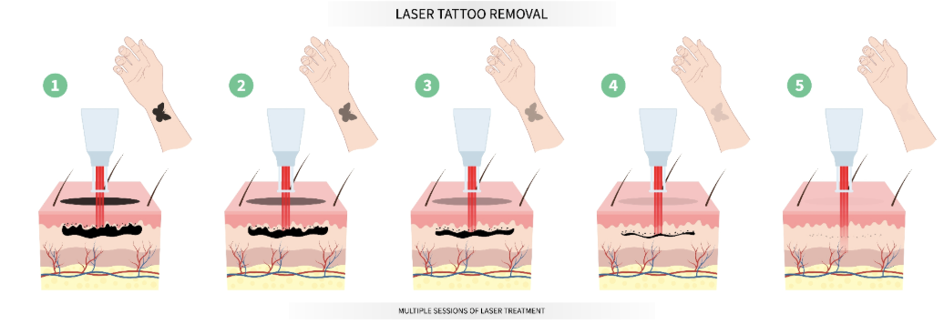 5-step laser tattoo removal process infographic