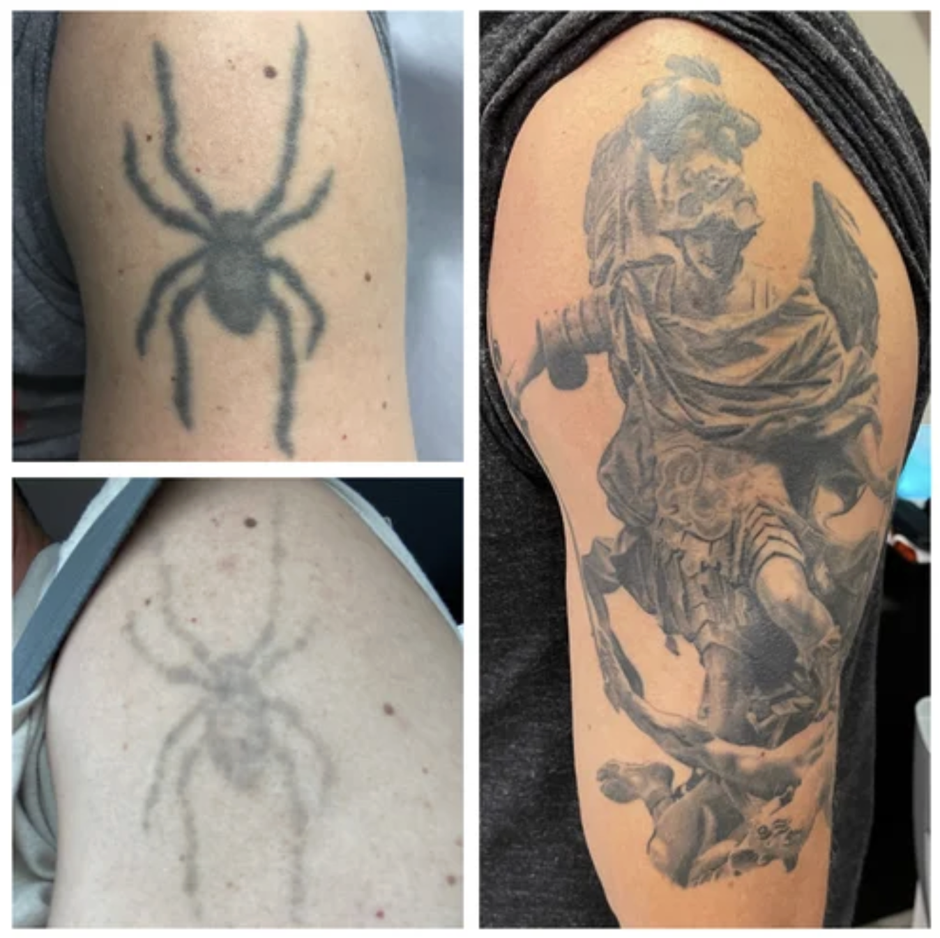 Before and after tattoo removal — Arm — Cover-Up Prep · 3 sessions