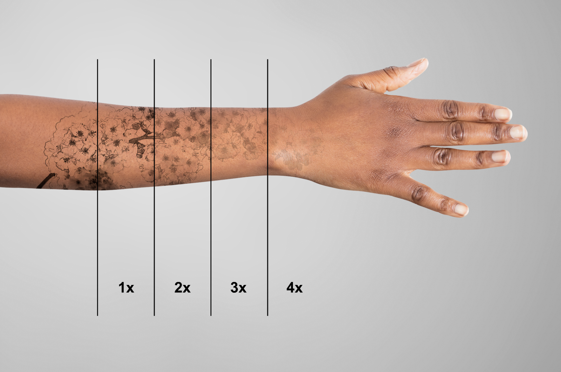 Tattoo fading progression over multiple laser removal sessions