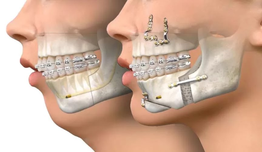 Cirurgia Ortognática: Mitos e Verdades