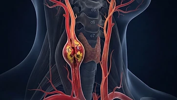 Dissecção arterial: quando dor no pescoço e dor de cabeça podem indicar uma alteração vascular