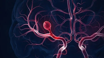 Dor de cabeça e aneurisma cerebral: quando devemos nos preocupar?