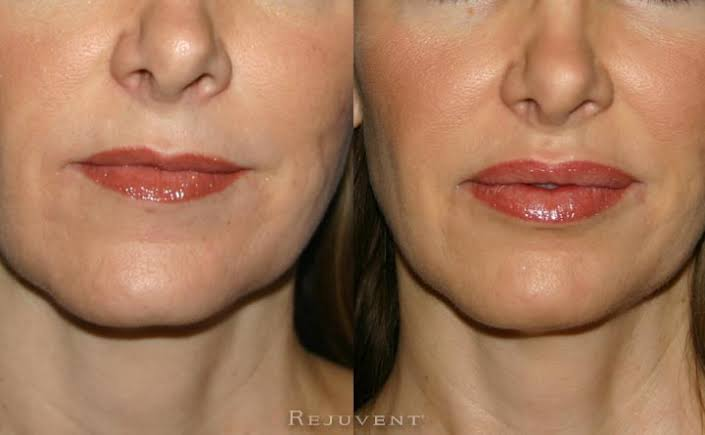 Before & After 12