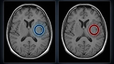 Side-by-side abstract brain MRI comparison showing two similar ring-enhancing lesions on a dark background