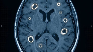 MRI-style brain scan showing multiple ring-enhancing lesions on a dark clinical background