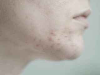 Niacinamide for Acne-Prone Skin: What the Evidence Shows
