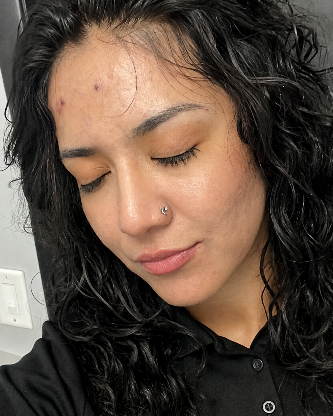 Acne results
