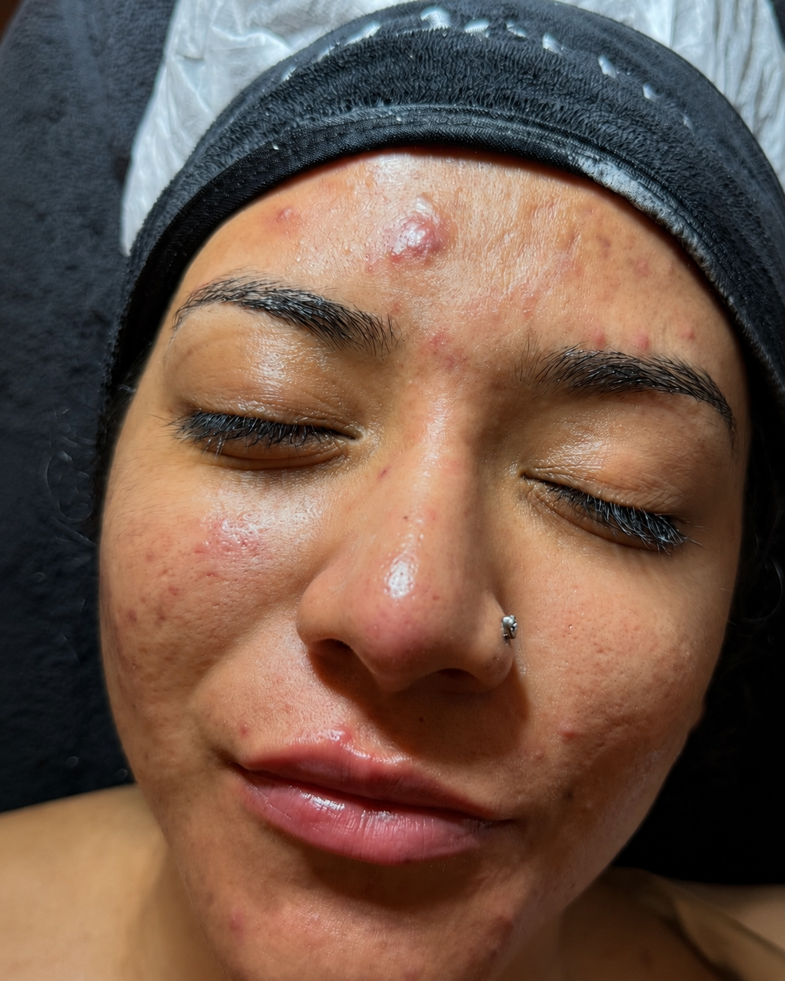 Acne results
