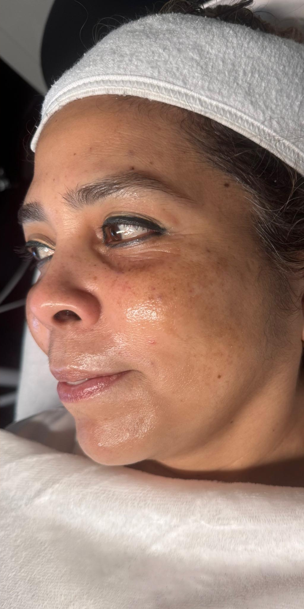 Pigmentation results