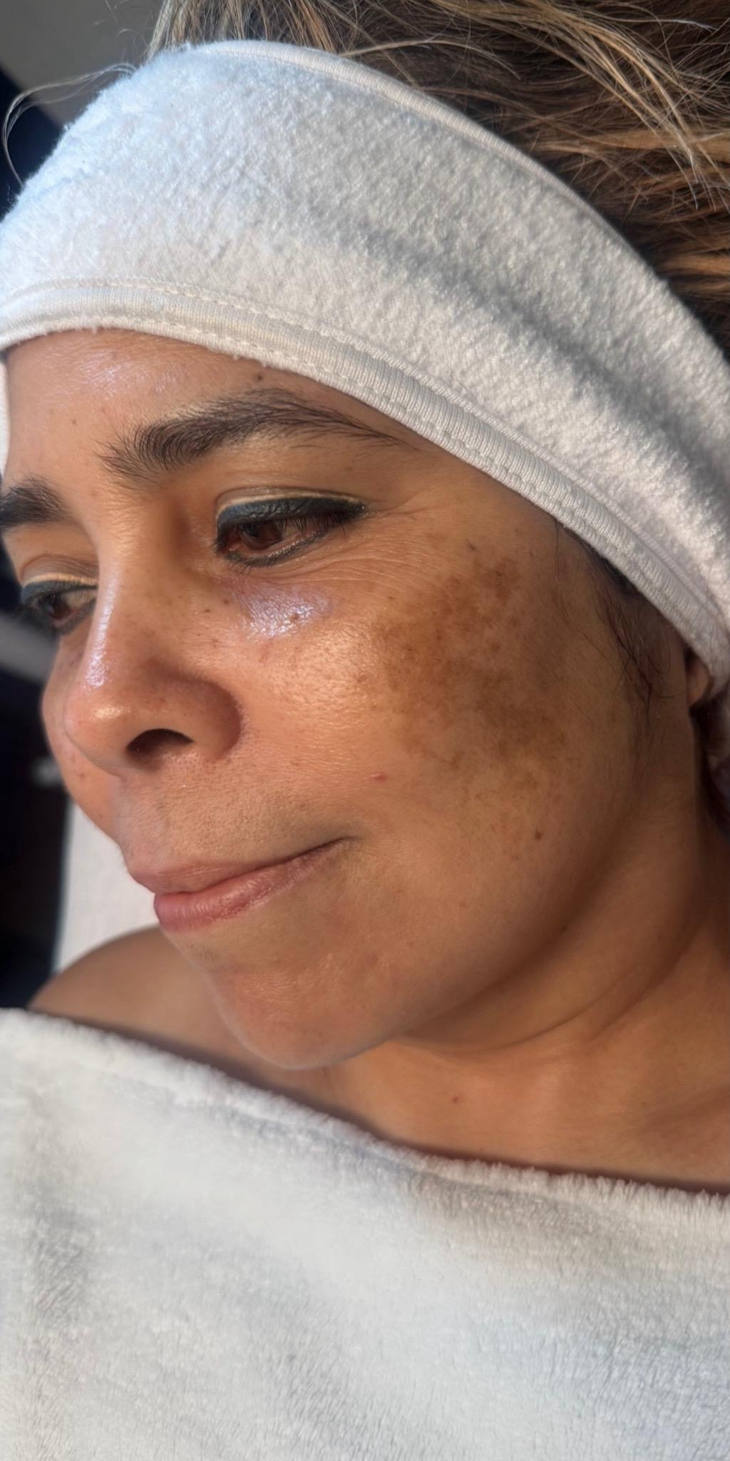 Pigmentation results