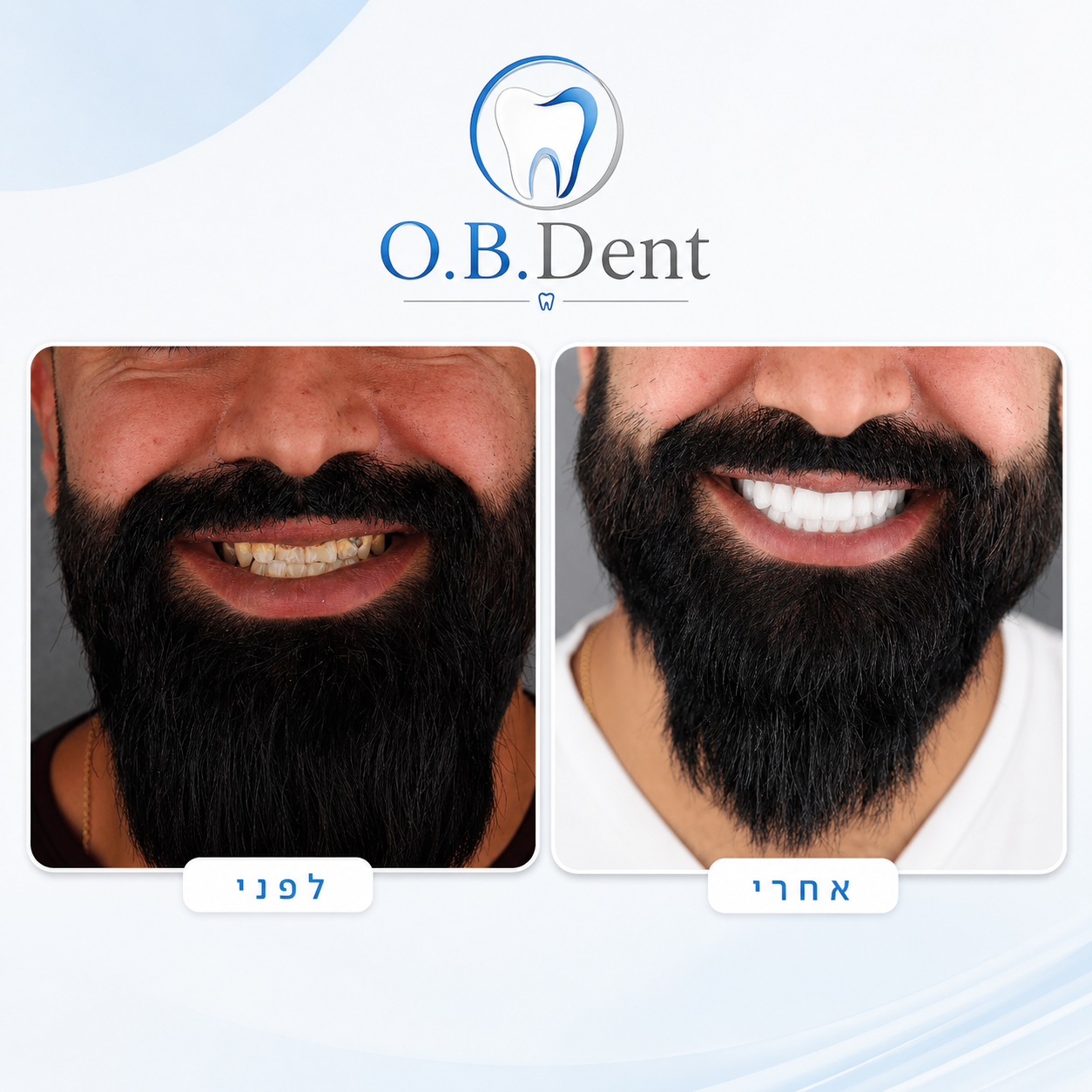 ציפויי EMAX לפני ואחרי - O.B Dent