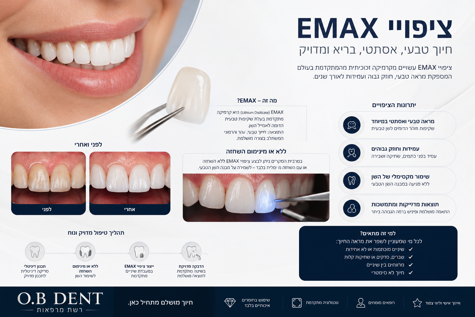 ציפויי EMAX - חומר, עמידות ותהליך ב-O.B Dent