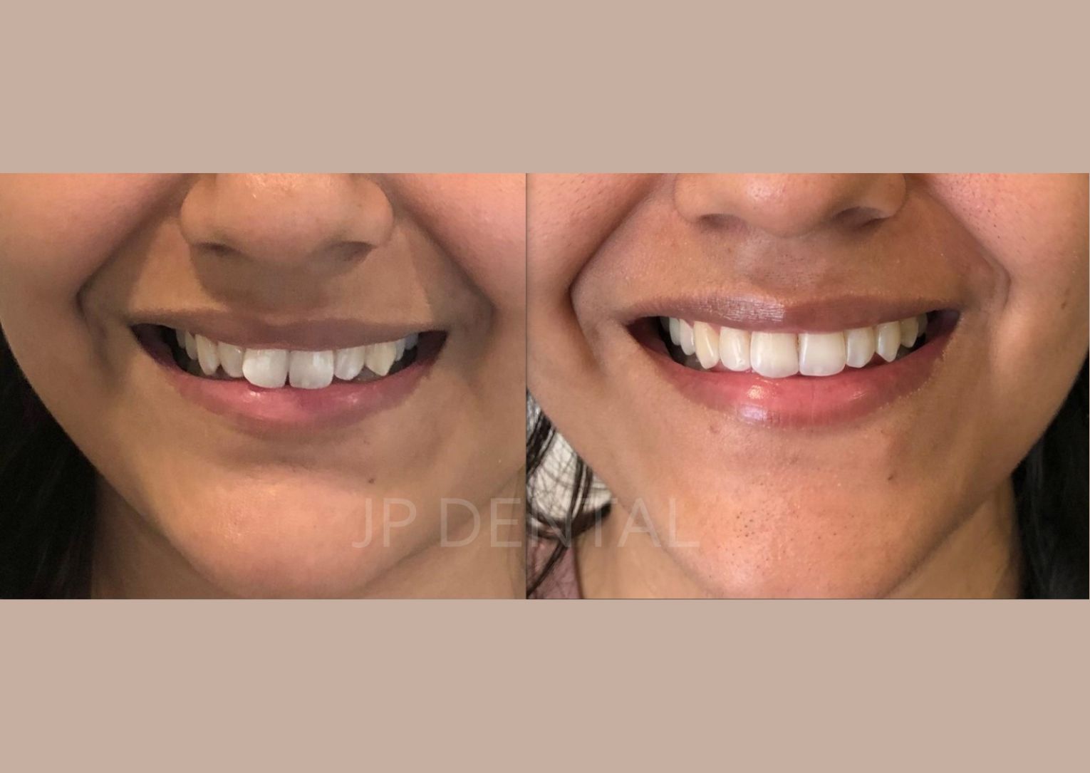 Before and after Smile Makeover
