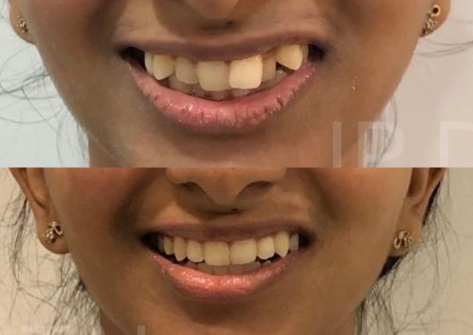 Before and after Smile Alignment