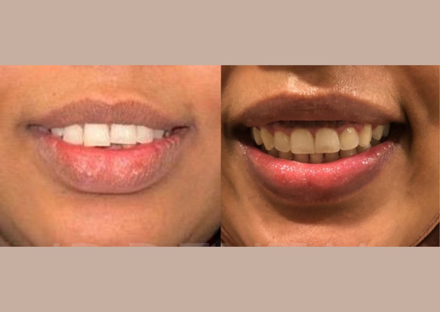 Before and after Gap Closure