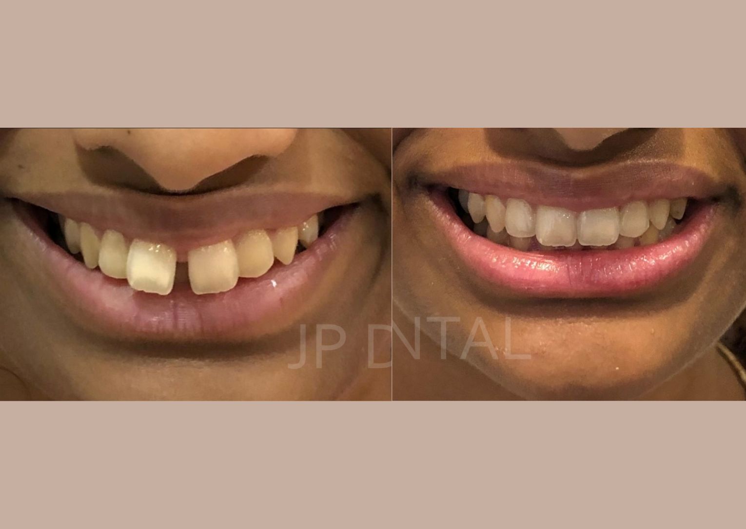 Before and after Diastema Closure