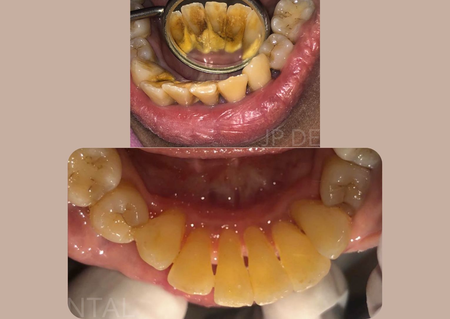 Before and after Deep Cleaning