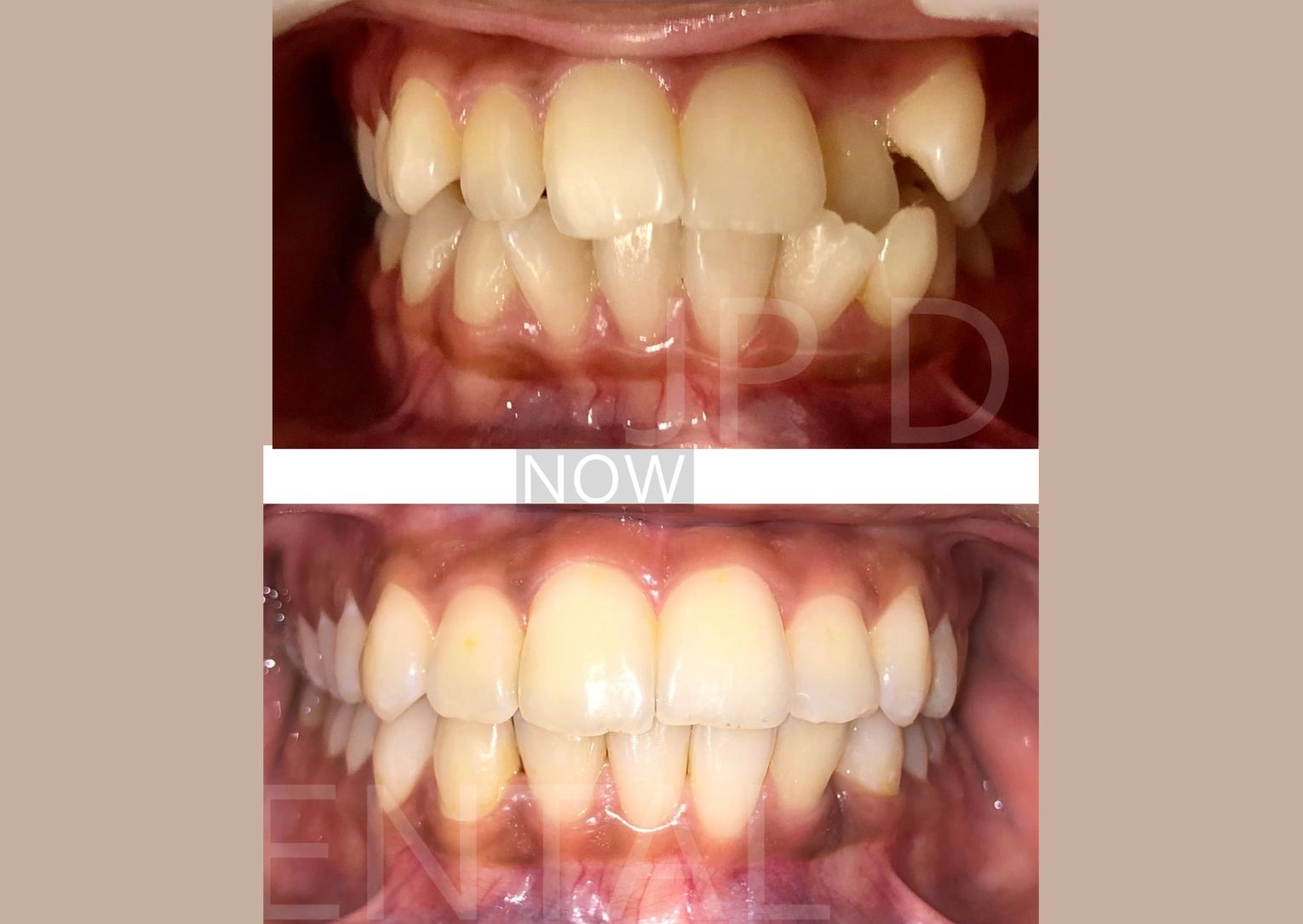 Before and after Orthodontic Alignment