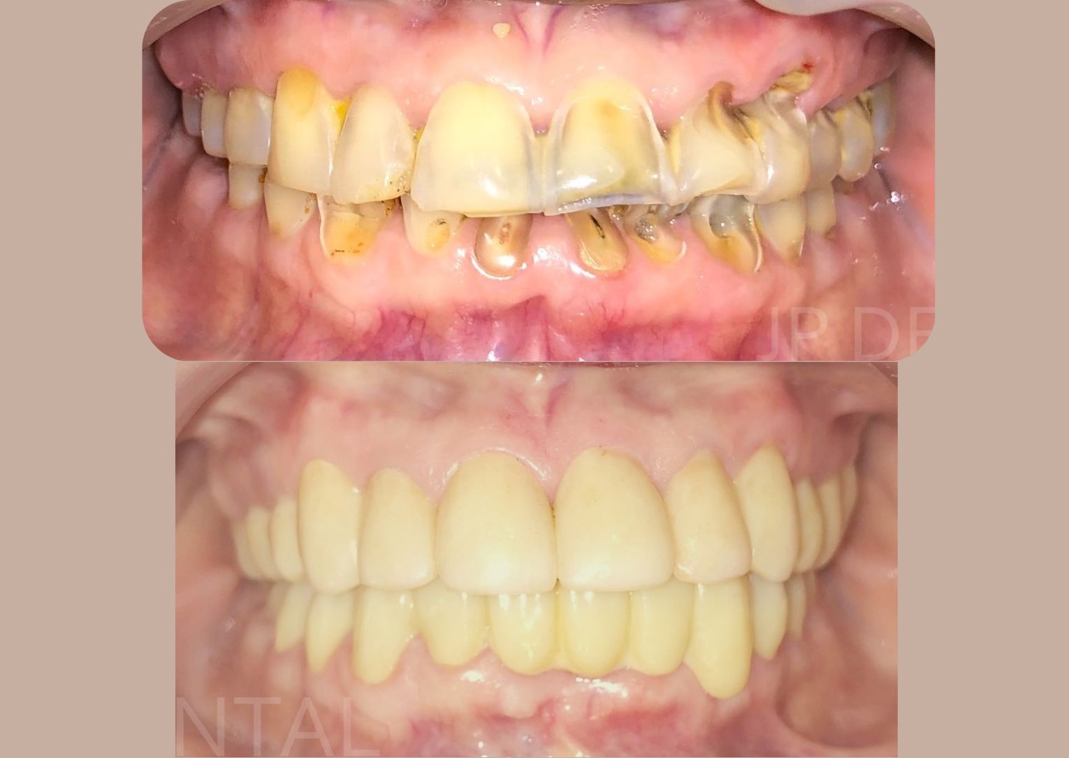 Before and after Full Mouth Restoration