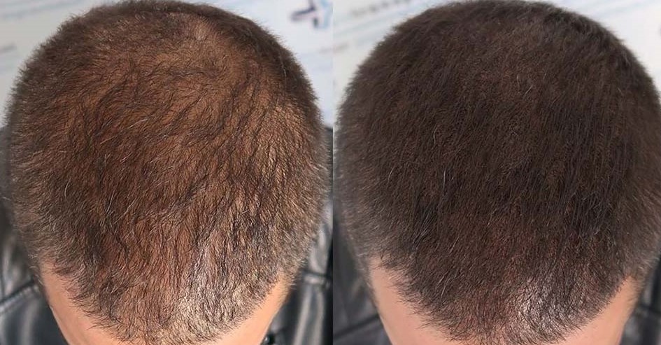Hajmikropigmentáció előtte – halántéki ritkulás
