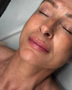 Facial treatment — Result