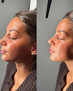 Profile refinement — Before / After