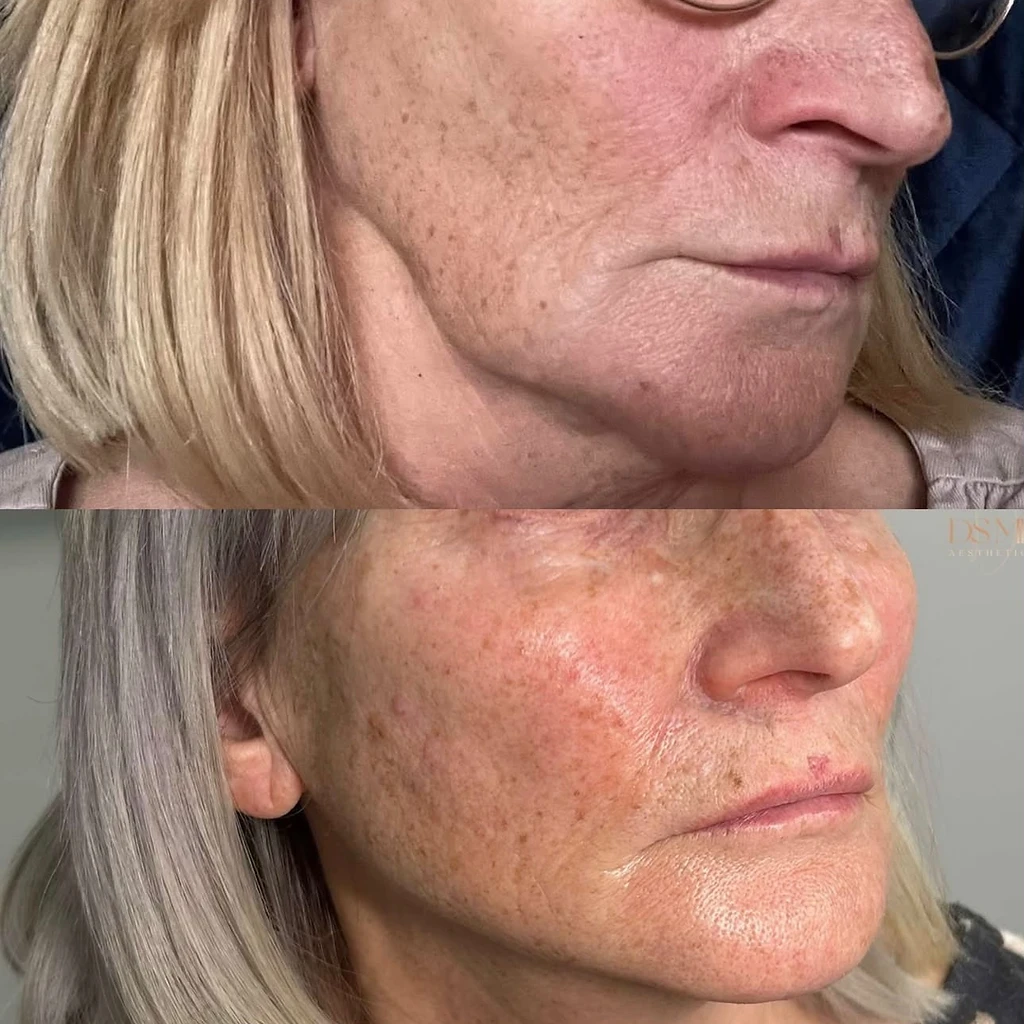 Skin rejuvenation — Before / After