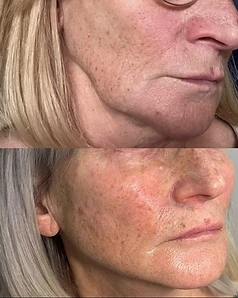 Skin rejuvenation — Before / After