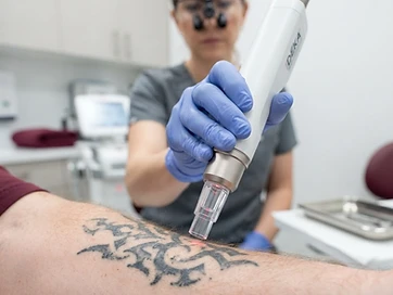 Laser Tattoo Removal