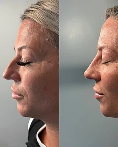 Dermal filler — Before / After