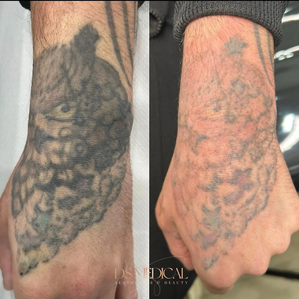Tattoo removal — Before / After