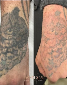Tattoo removal — Before / After