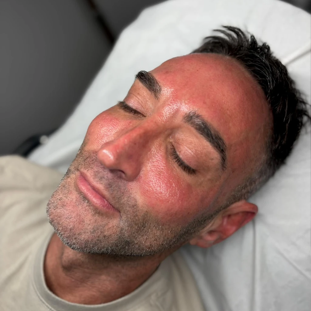 Laser treatment — Result