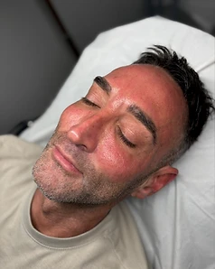 Laser treatment — Result