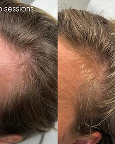 Hair restoration — Before / After