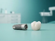 Implantes Dentales