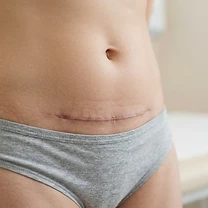 Caesarean Section (C-Section) Recovery